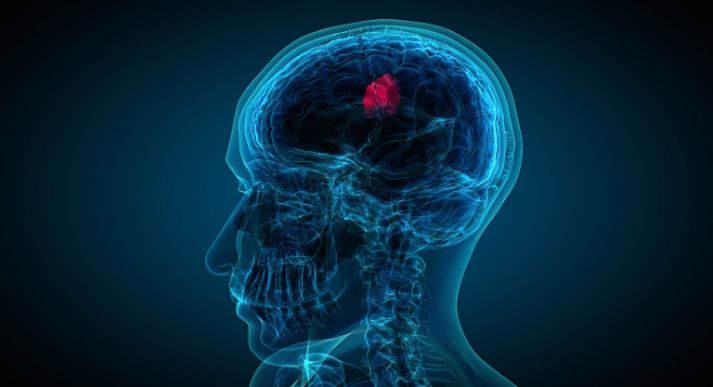 Operasi tumor otak : apa yang harus anda ketahui sebelum memutuskan untuk melakukannya